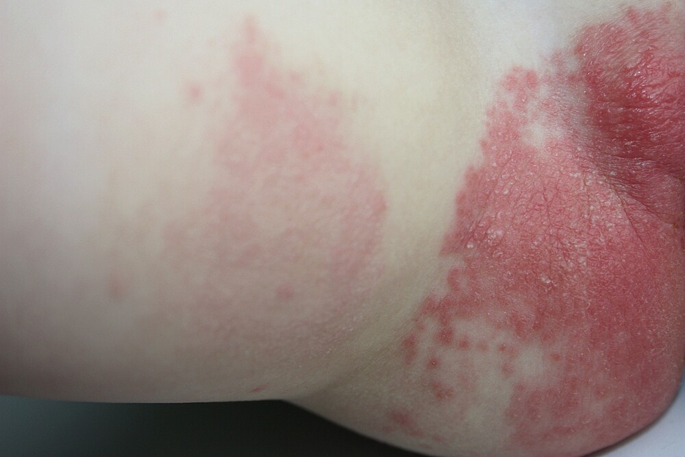 Prevention and Treatment of Diaper Dermatitis