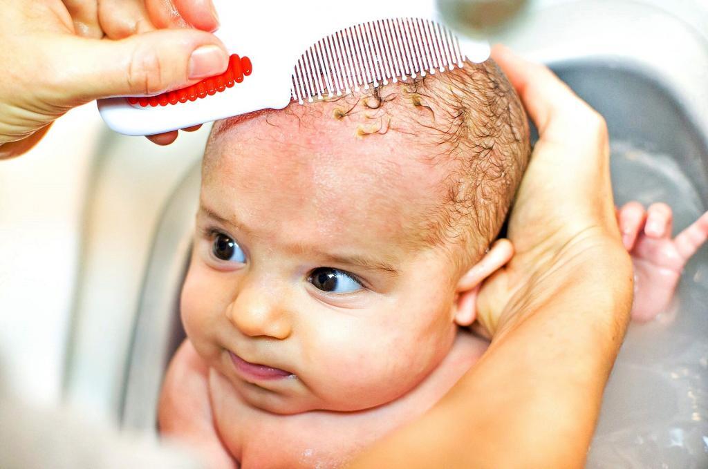 cradle-cap-recognition-and-treatment