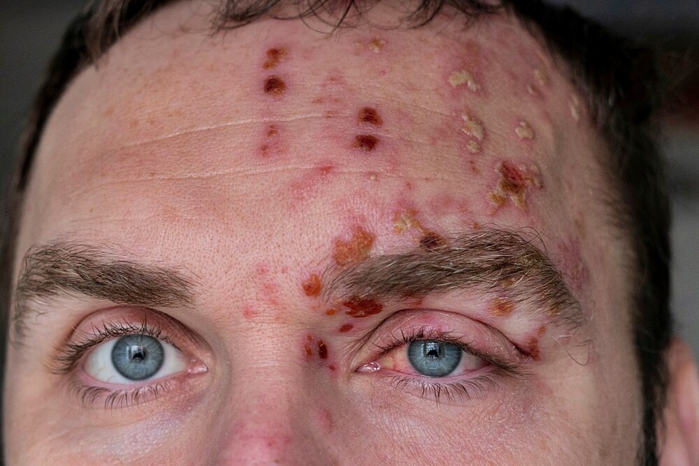 Eye Herpes Pictures Symptoms And Types 