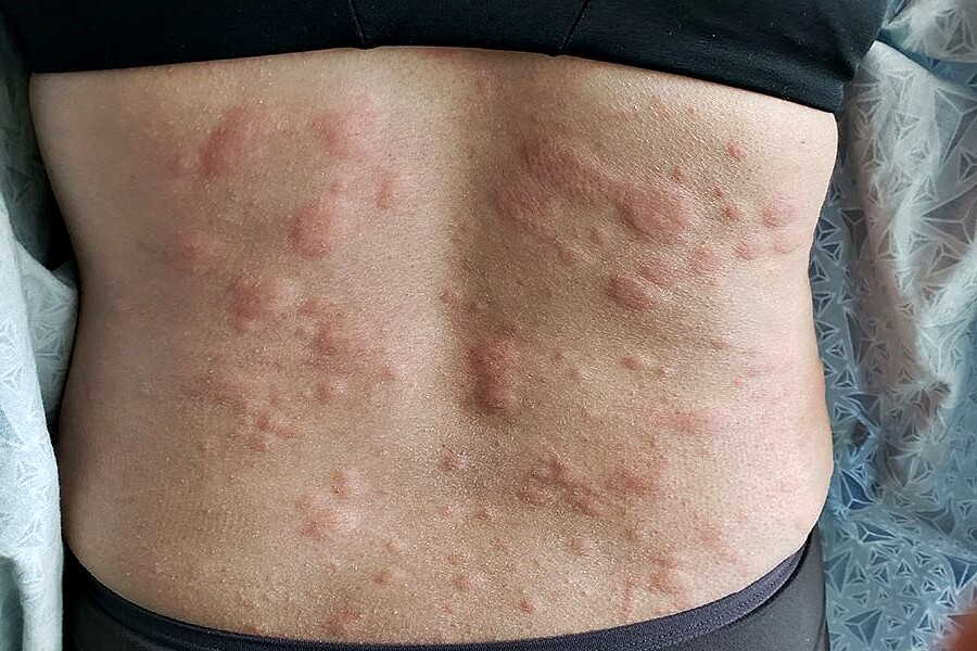 Home Remedies For Hives What Really Helps 