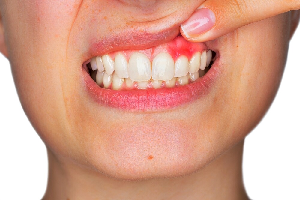 Home Remedies Against Inflamed Gums 5 Practical Tips 