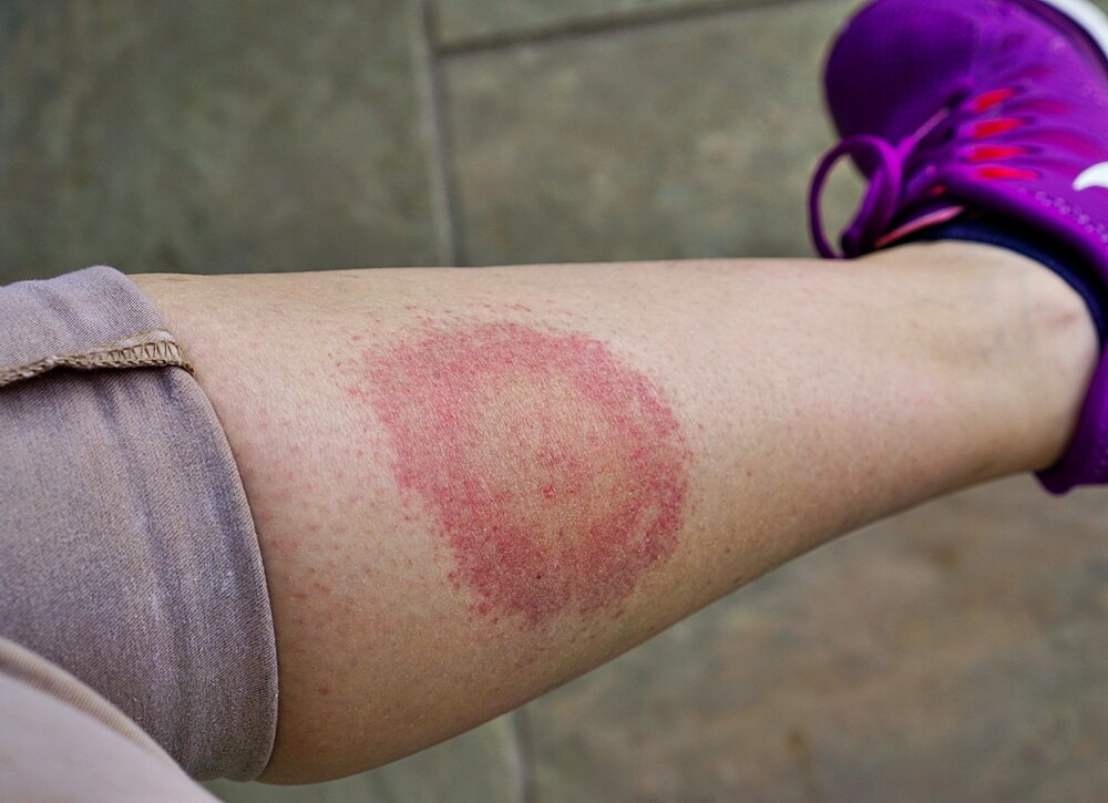 Lyme Disease Symptoms That s How You Recognize Them