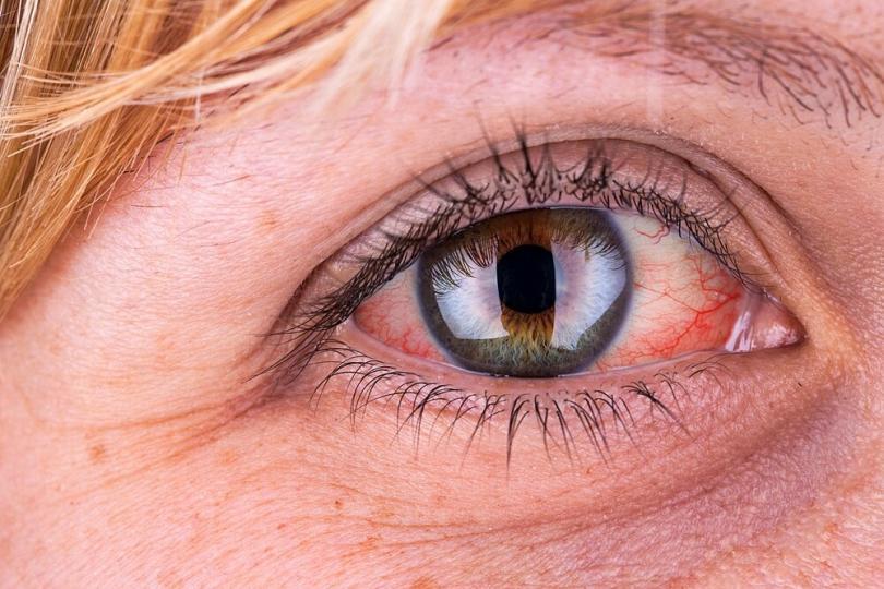 Red Eyes Causes Treatment And Tips Womens Alphabet 