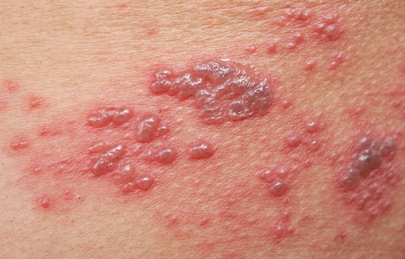 Shingles: This is why the viral disease is so insidious | Women's Alphabet