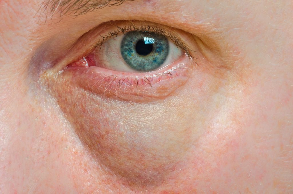 What Causes Blue Bags Under Your Eyes