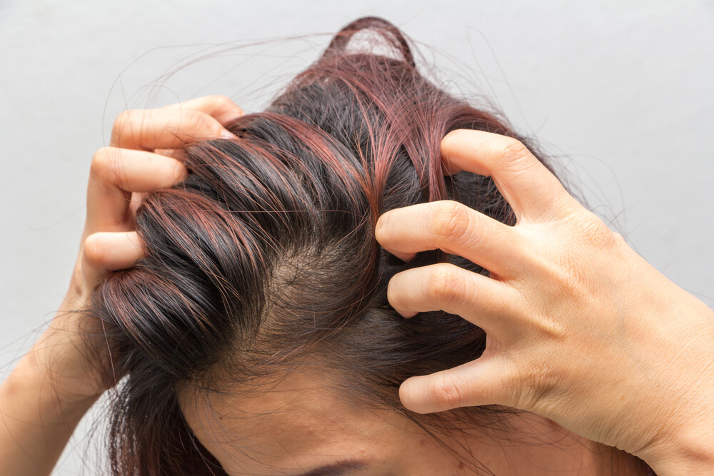 Itchy Scalp Causes And Home Remedies