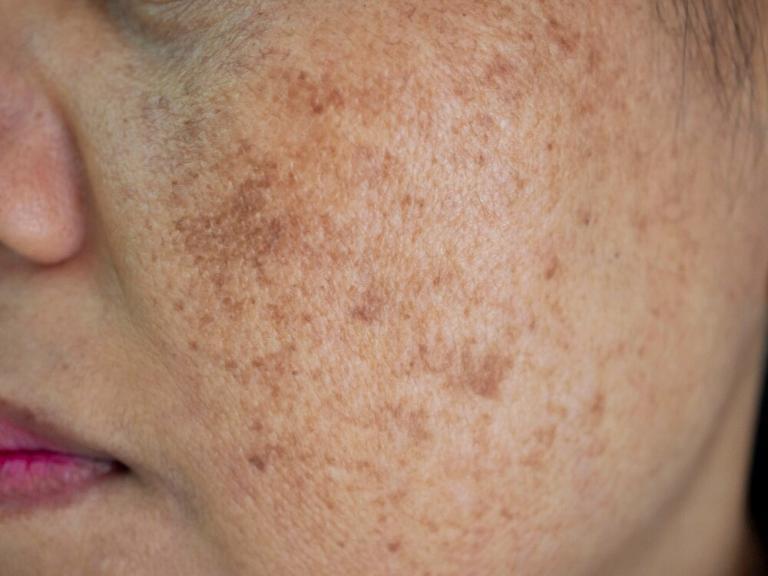 Home Remedies for Pigmentation: How to Remove Dark Spots | Women's Alphabet