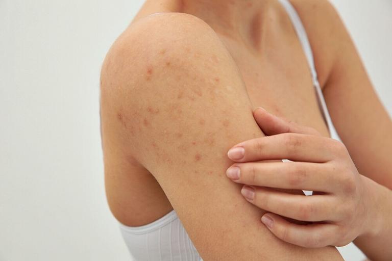 What Causes Pimples On The Arms