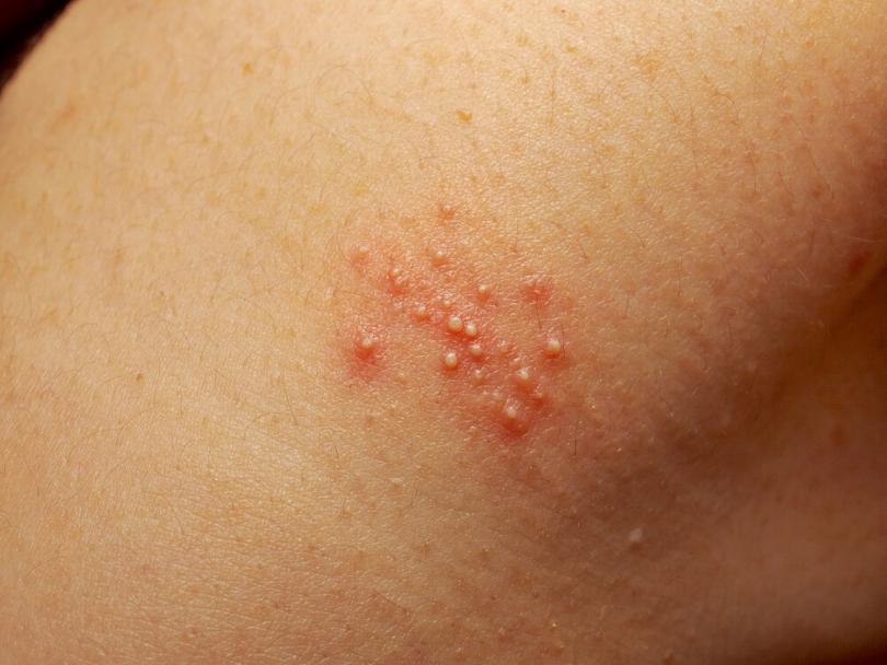 heat-rash-in-adults-pictures-remedies-for-rashes-how-to-cure-rashes