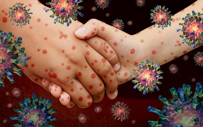 Chickenpox Overview Causes And Symptoms Women S Alphabet