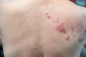 Shingles (Herpes Zoster): Symptoms, Treatment & Prevention