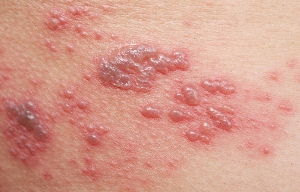 Shingles (Herpes Zoster): Symptoms, Treatment & Prevention