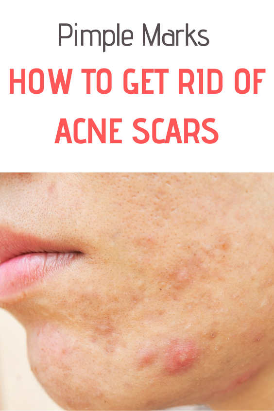 Pimple Marks: How to Get Rid of Acne Scars