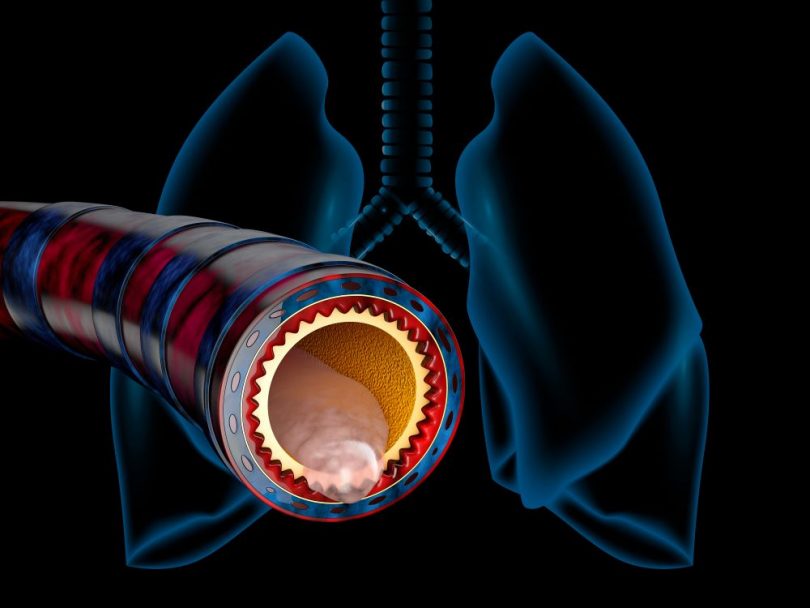 What Does Bronchial Breathing Indicate