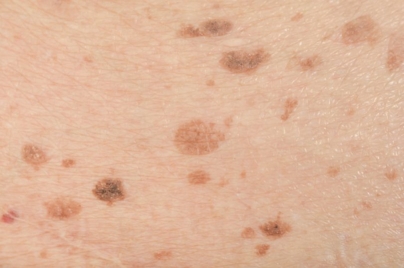 What Do Liver Spots On Your Skin Look Like - Printable Templates Protal