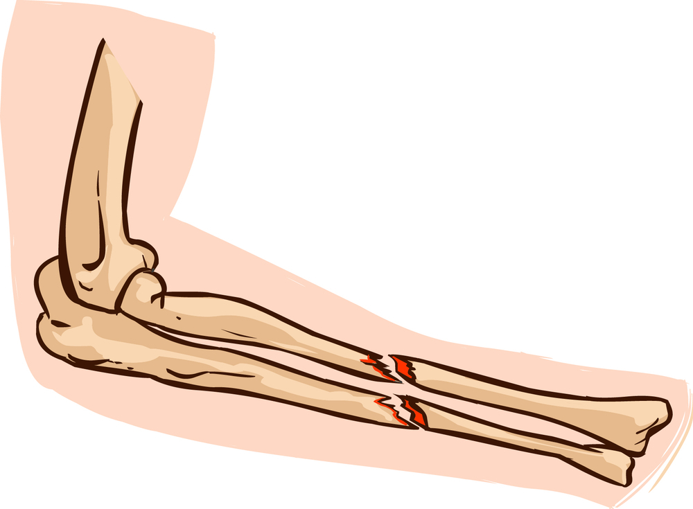 Bones that can be broken as a result of traffic accidents