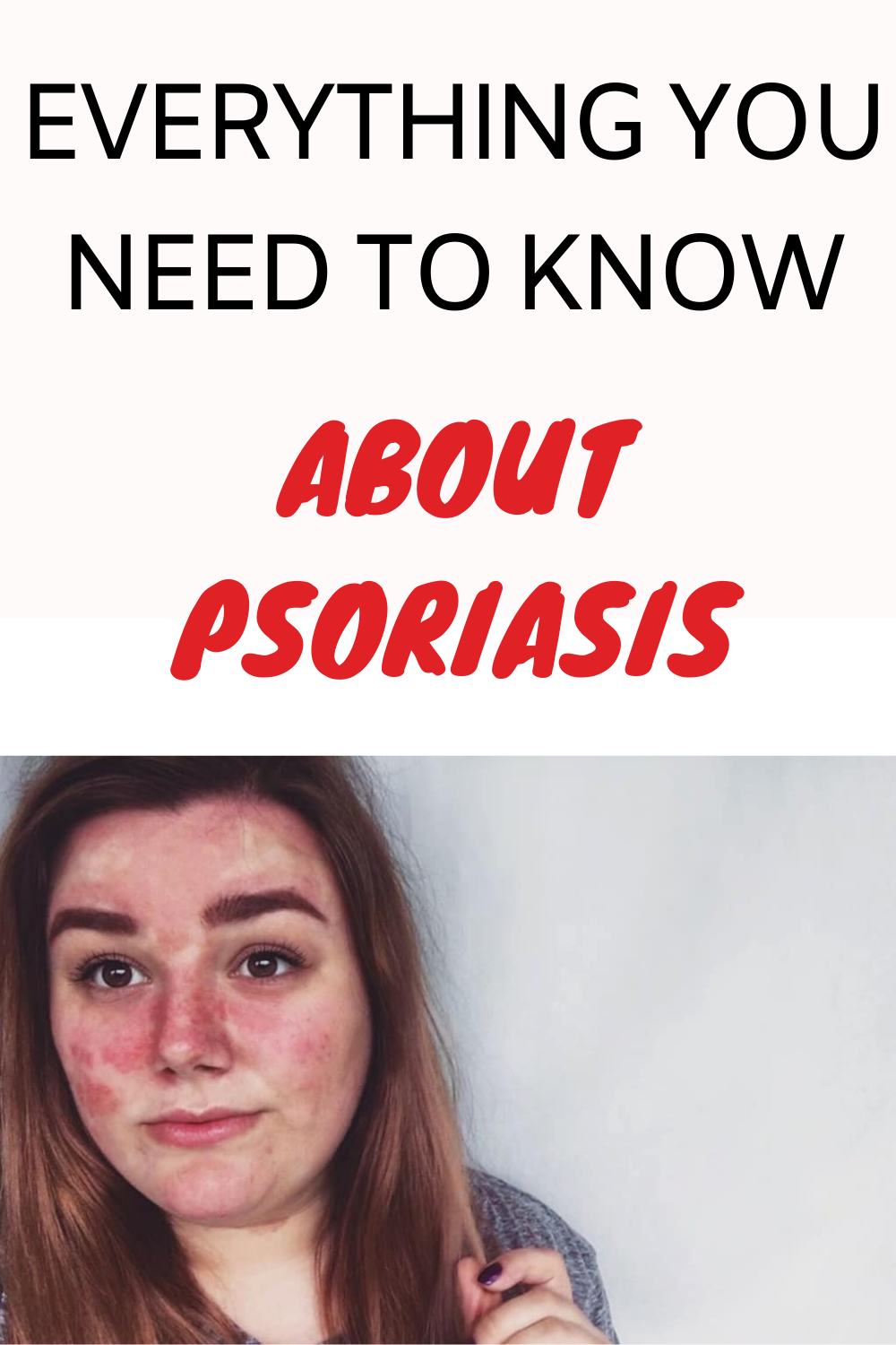 Everything You Need To Know About Psoriasis 