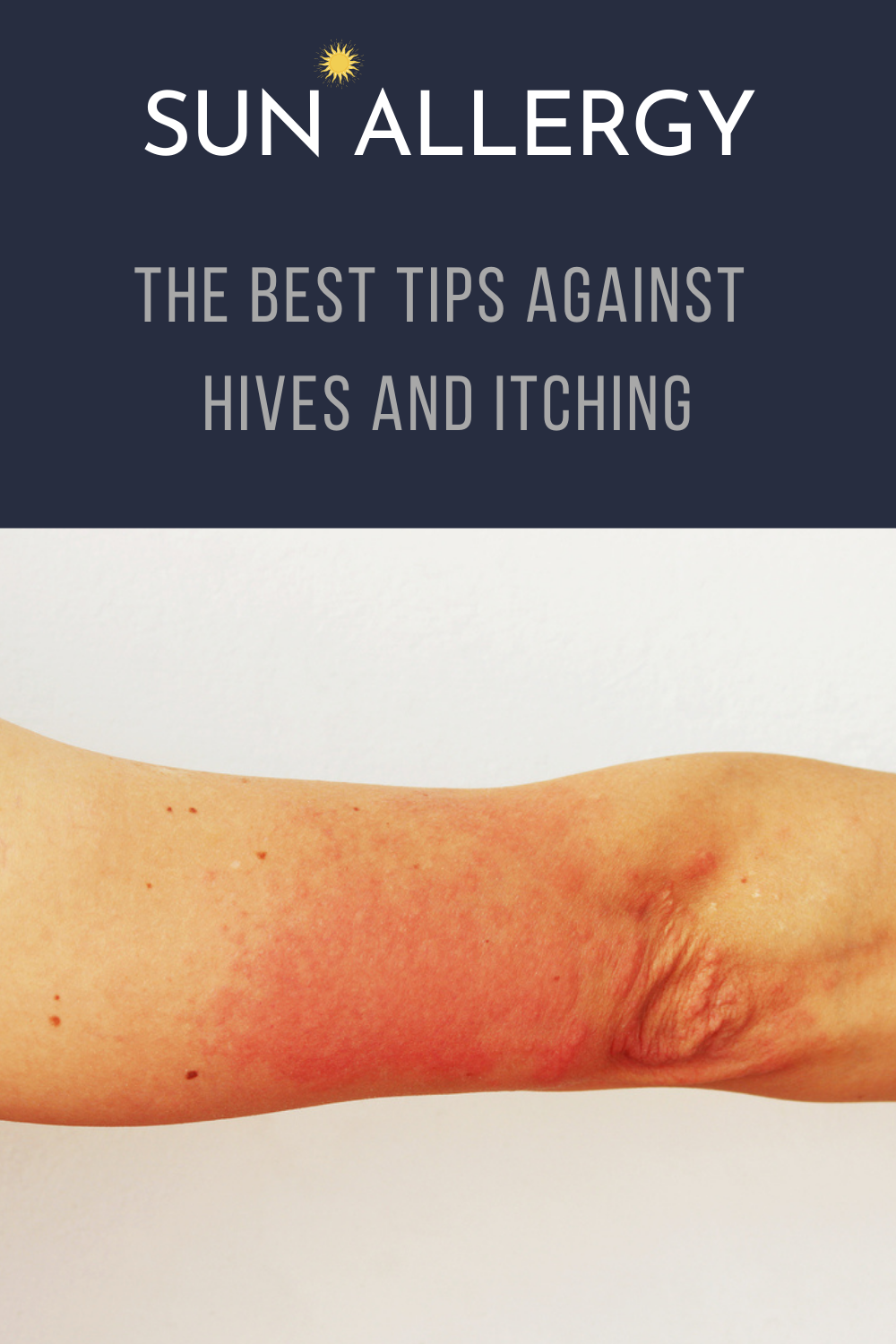 sun-allergy-the-best-tips-against-hives-and-itching