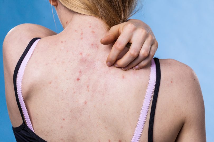 Best Tips for Preventing Cold-Weather Acne | Women's Alphabet