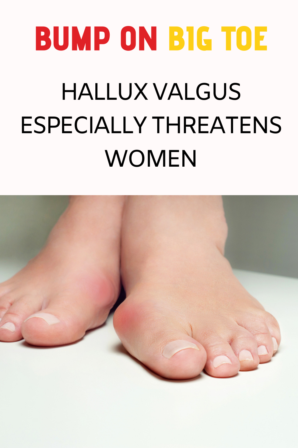 bump-on-big-toe-hallux-valgus-especially-threatens-women