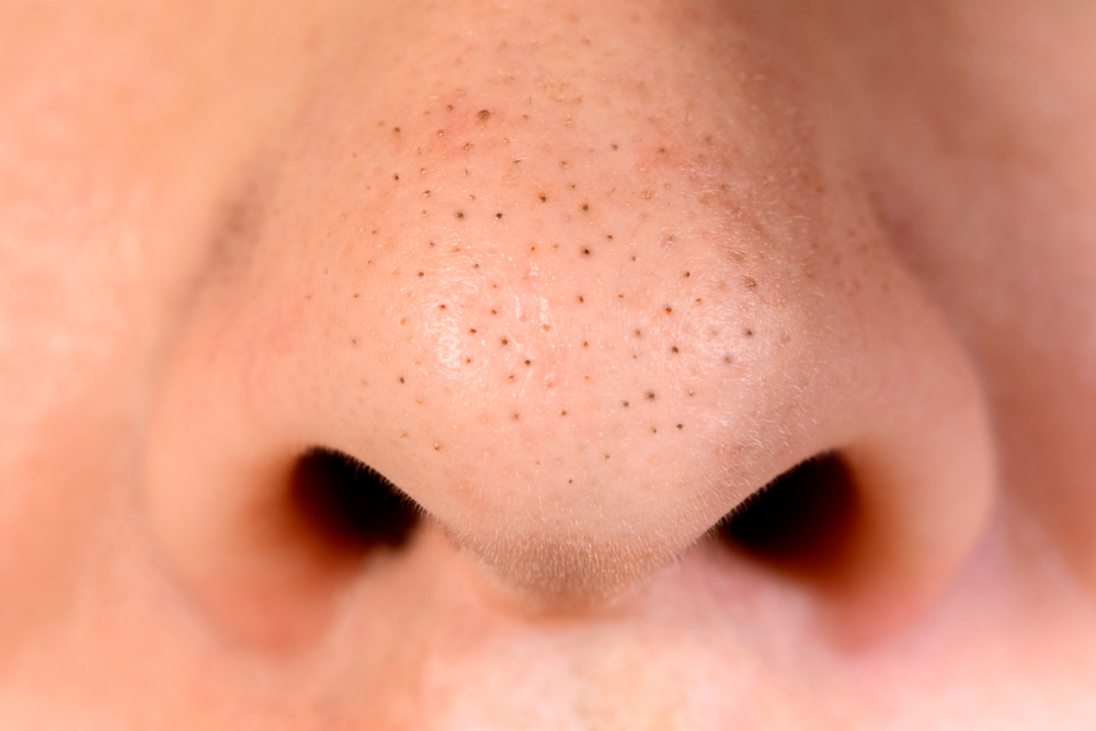 8 Natural Home Remedies To Get Rid Of Blackheads Women s Alphabet