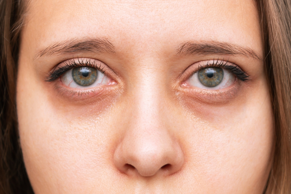 Laser Treatments for Dark Circles Under Eyes Women's Alphabet